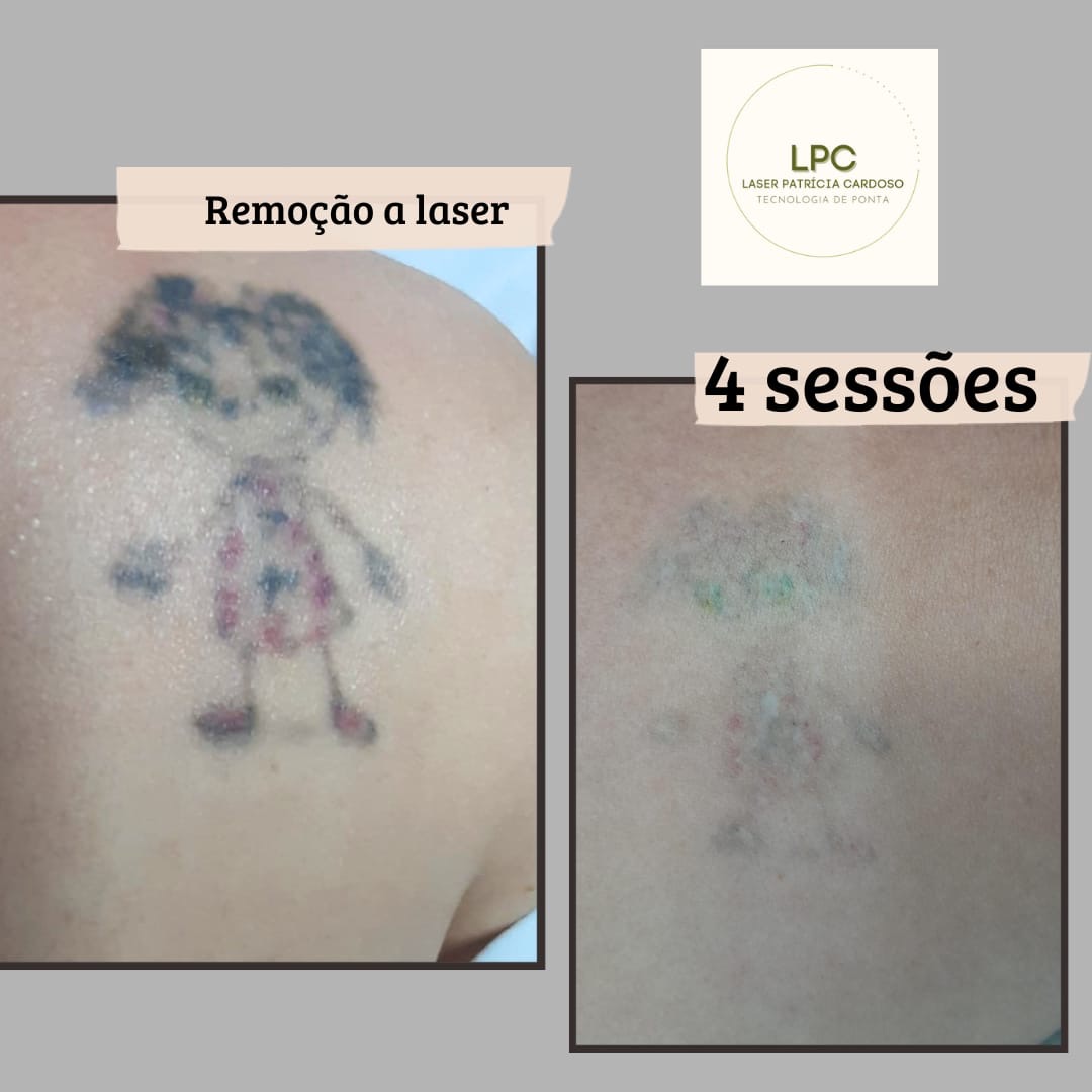 remocao-tatuagem-laser-patricia-cardoso-01