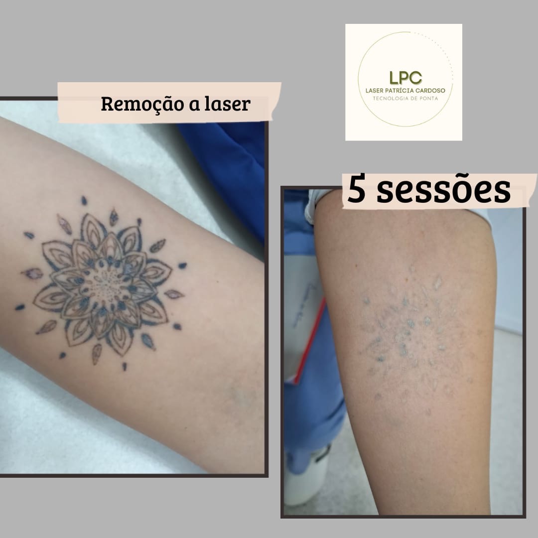 remocao-tatuagem-laser-patricia-cardoso-02