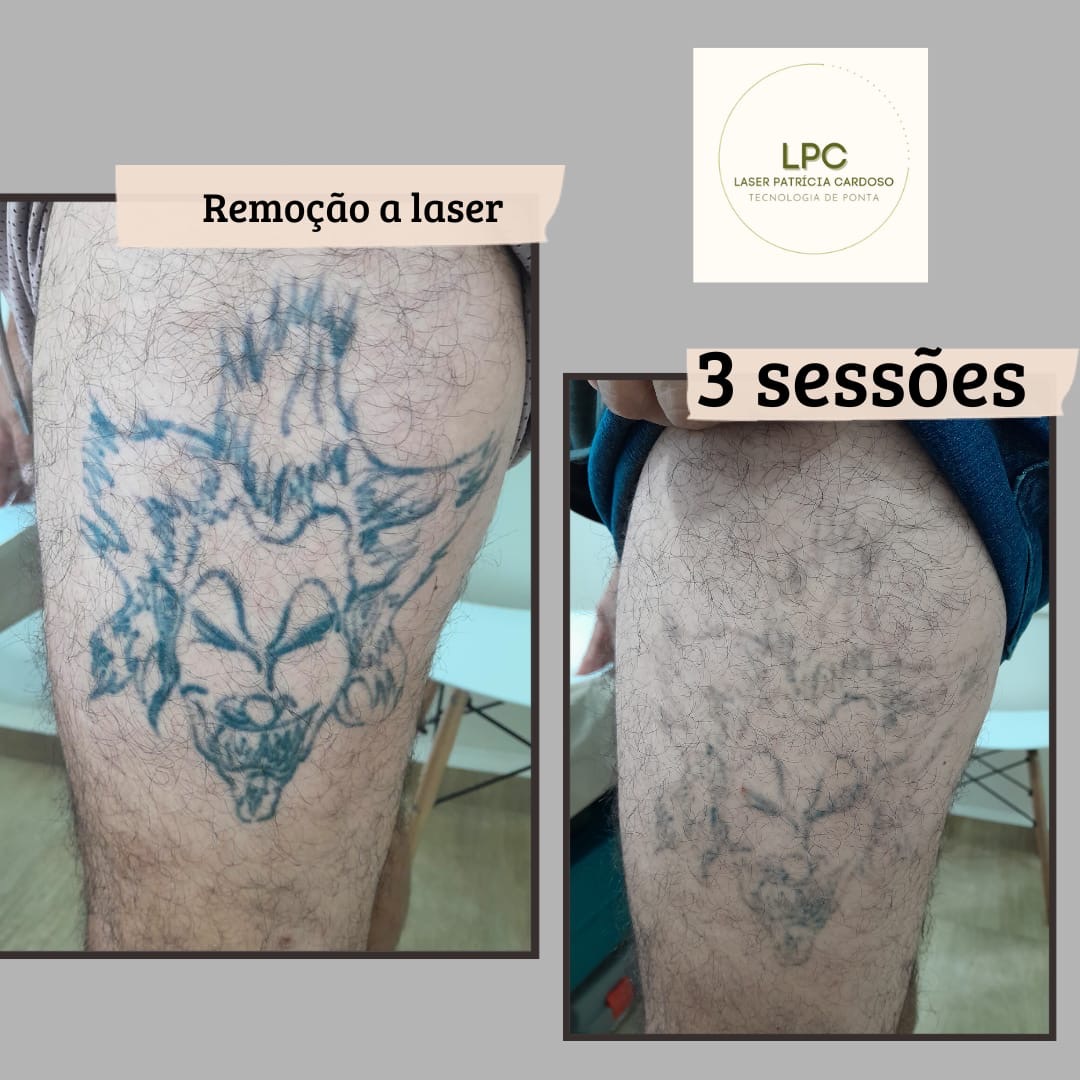 remocao-tatuagem-laser-patricia-cardoso-05