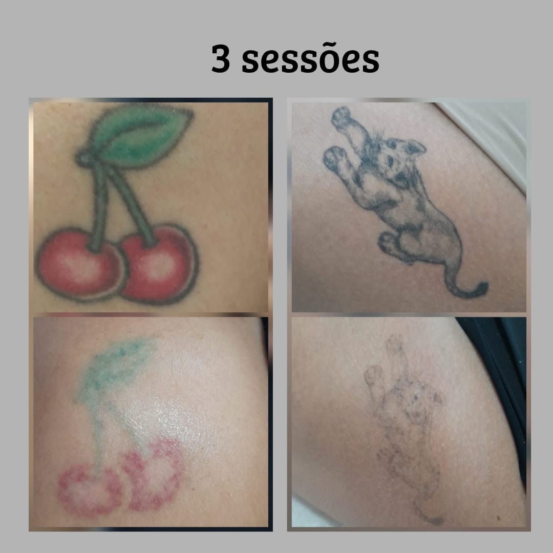 remocao-tatuagem-laser-patricia-cardoso-06